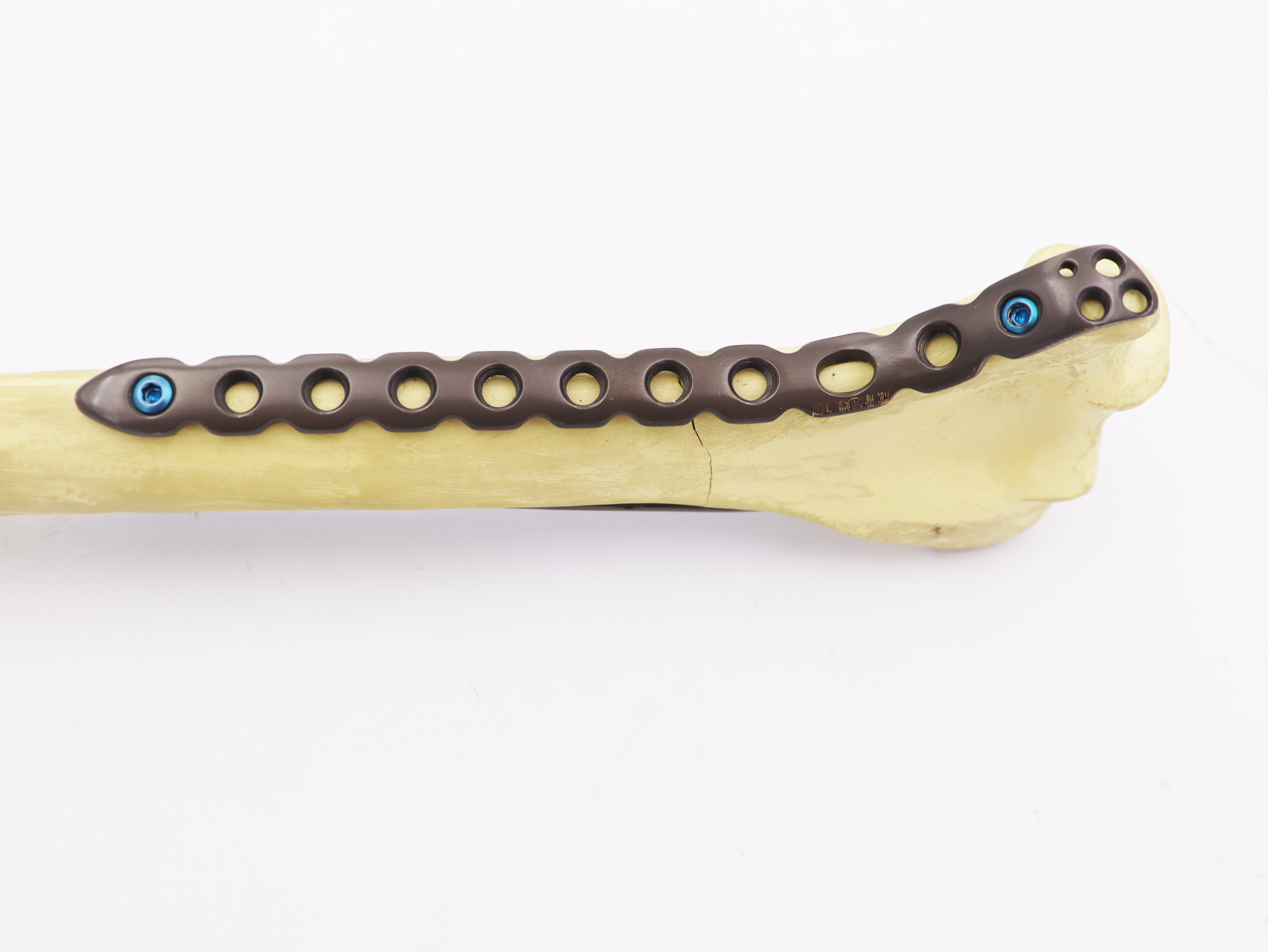 Orthopedic Implants bone fracture Distal Humeral Medial Locking plate for humerus(left/right)