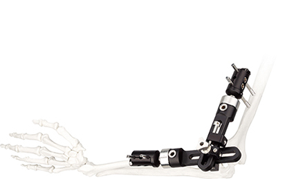 orthopedic medical high quality orthopedic elbow joint external fixator for elbow joint bone fracture