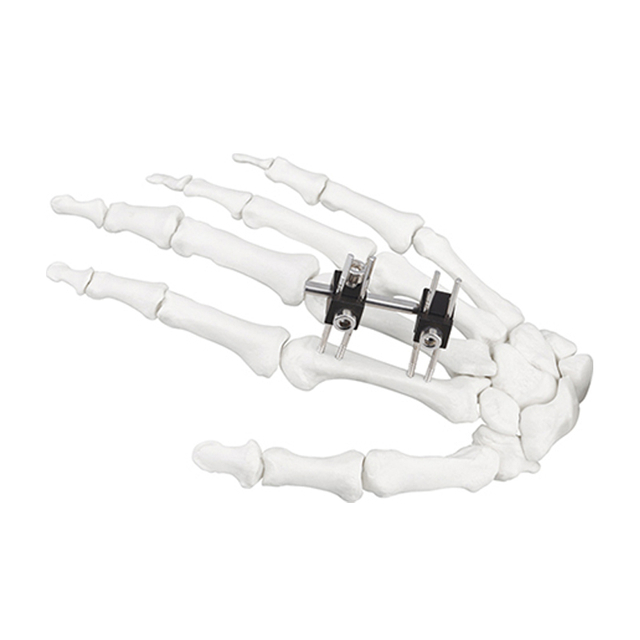 Jinlu Medical orthopedic bone fracture Mini fixator universal type for finger fracture