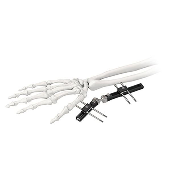 Orthofix Wrist External Fixators（Single Locking Type） for Orthopedic Fixation