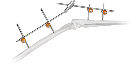 Hoffman design Combinational external fixators