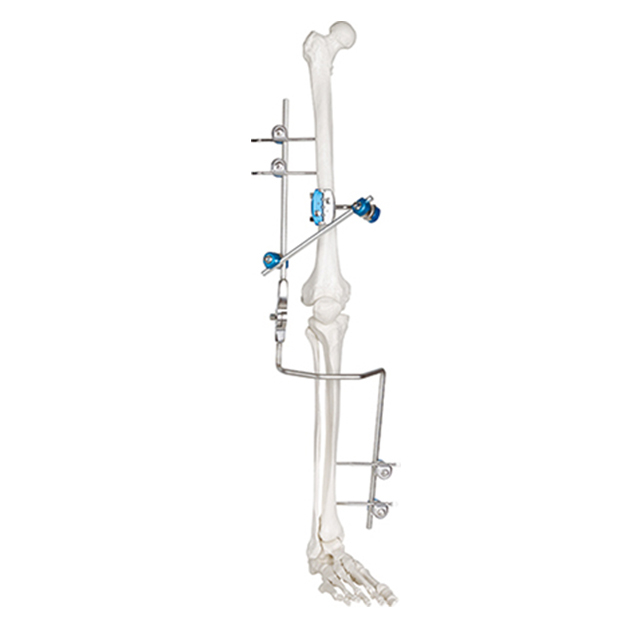  Hoffman DesignCombinational Knee Joint External Fixators for Orthopedic Fixation