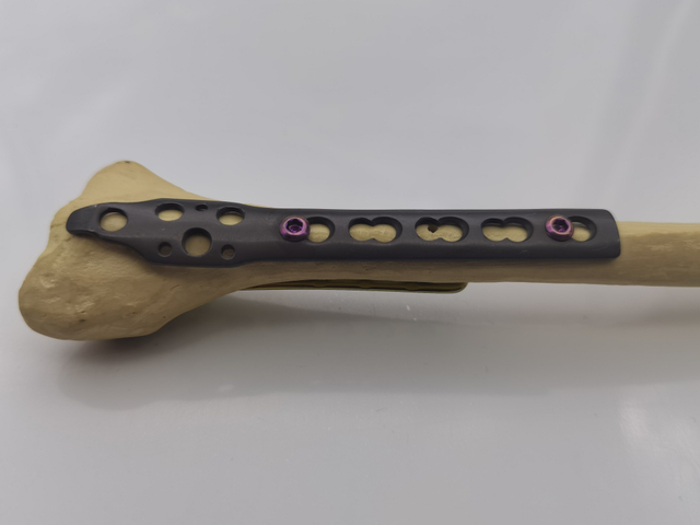 Hot selling Orthopedic Implants big fracture Distal Radius/Fibular titanium locking plate 