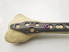 Jinlu Medical Orthopedic Implants big fracture Distal Radius/Fibular locking plate of pure titanium 