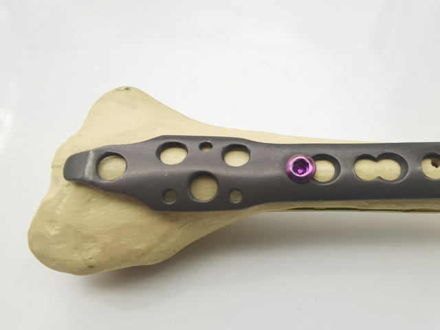 Hot selling Orthopedic Implants big fracture Distal Radius/Fibular titanium locking plate 