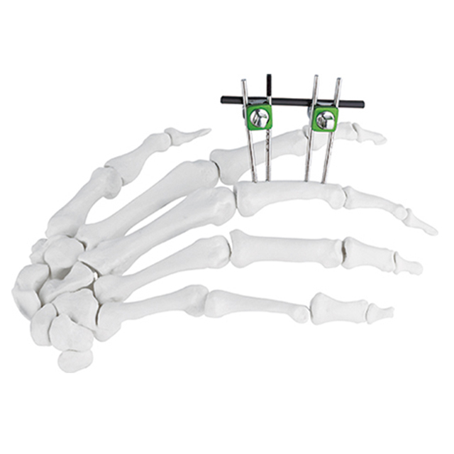Orthopedic Hoffman Design Combinational Mini External Fixators for Finger&palm
