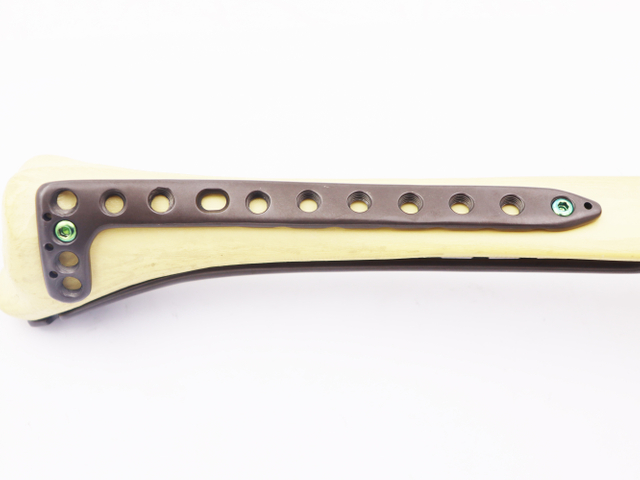 Orthopedic surgical Implants bone Big fracture distal Tibia Anterolateral Locking plate(left/right)(combination hole)