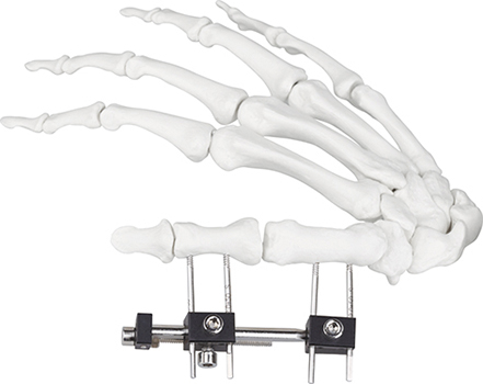 Jinlu Medical orthopedic bone fracture Mini fixator universal compression extension type for finger fracture