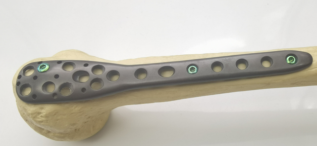 Orthopedic surgical Implants Proximal Humeral Condylus humerus Locking plate