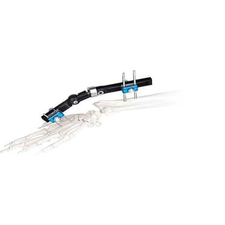 Orthofix Wrist External Fixators(Half Ball Connection Type) for Orthopedic fixation