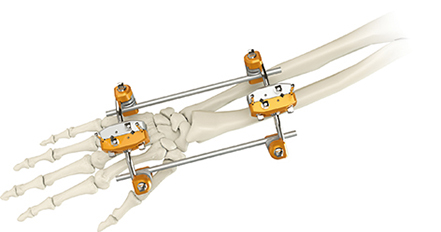 Combinational External Fixators