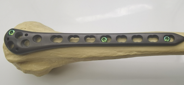 Orthopedic surgical Implants Proximal Humeral Condylus humerus Locking plate