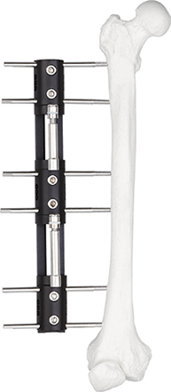 High quality orthopedic Limb reconstruction femur bone fracture external fixator B type fixation