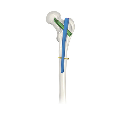 New Design PFNA(Gamma) Interlocking Nails for Femur with CE