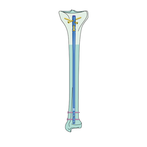 Orthopdic Implant Tibial Interlocking Nails(Expert Design) for Fixation