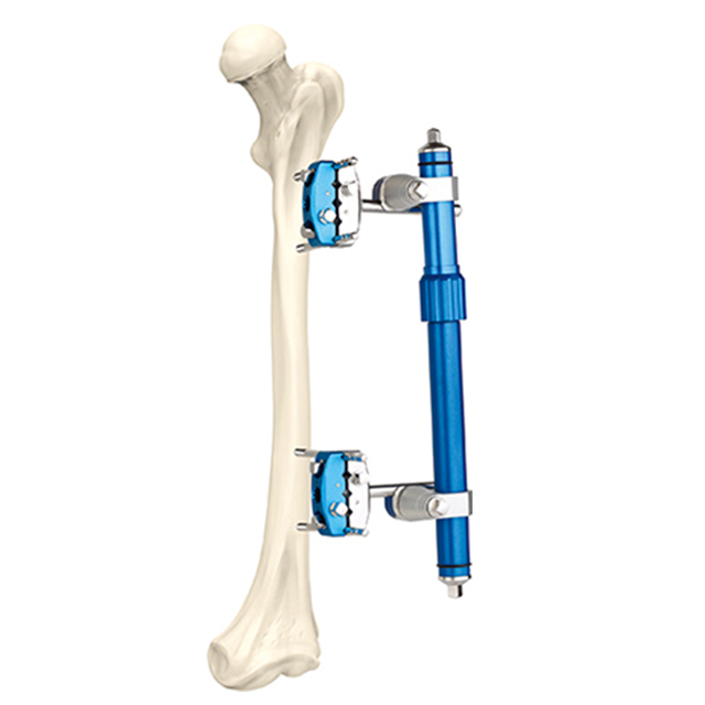 Hoffman DesignCombinational Micro-motion External Fixators for Orthopedic Fixation 