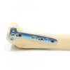 Orthopedic Implants interventional materials bone fracture Osteotomy T-shaped locking plate implants