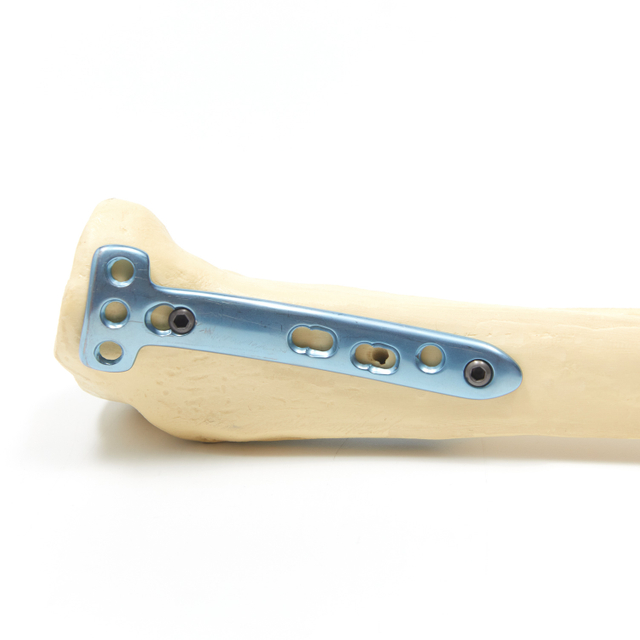 Orthopedic Implants interventional materials bone fracture Osteotomy T-shaped locking plate 