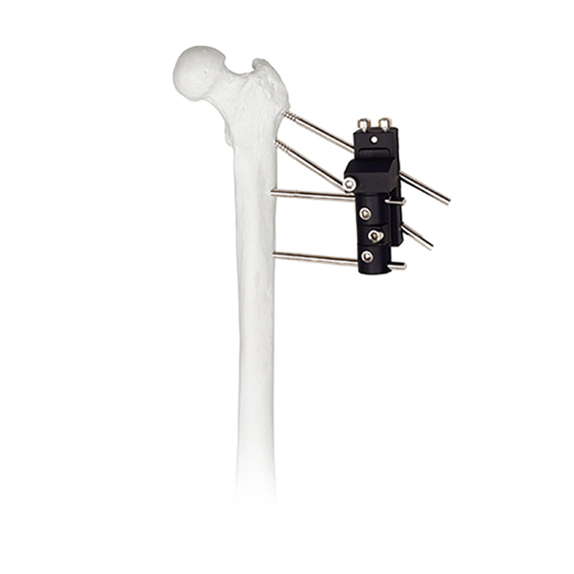 Jinlu Medical bone fracture orthopedic Pertrochanteric external fixator for femur