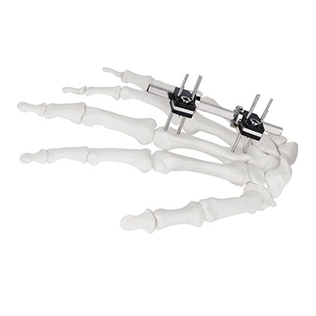 Orthofix Mini Straight Type External Fixators for Finger Orthopedic Fixation