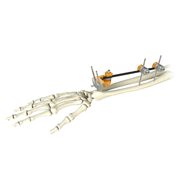 Hoffman design Combinational Distal radius External Fixators for Orthopedic fixation