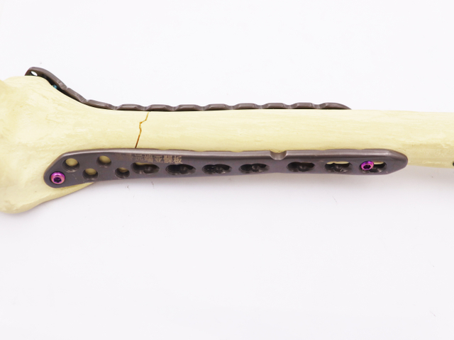 Hot selling Orthopedic Implants bone fracture Distal Humeral Sub-condylar Locking plate