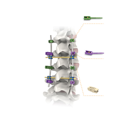 Spinal Products Pedicle Screw with Double Core And Double Thread