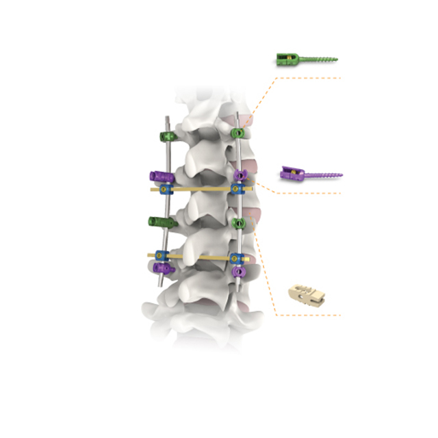 Manufacturer Spinal Products Pedicle Screw with Double Core And Double Thread