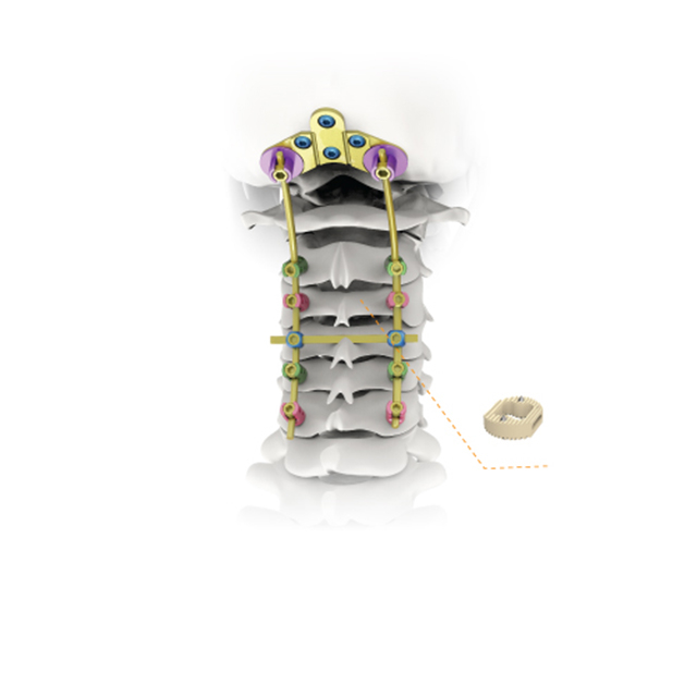 Manufacturer Spinal Products KCO 3.2 Posterior Cervical System for Orthopedic Implants