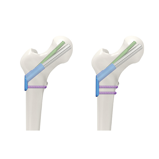 New Product FNS System for Femur Neck Fracture Interlocking Nails 