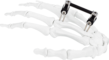 Jinlu Medical orthopedic Hand fixation Mini fixator combined type for finger bone fracture