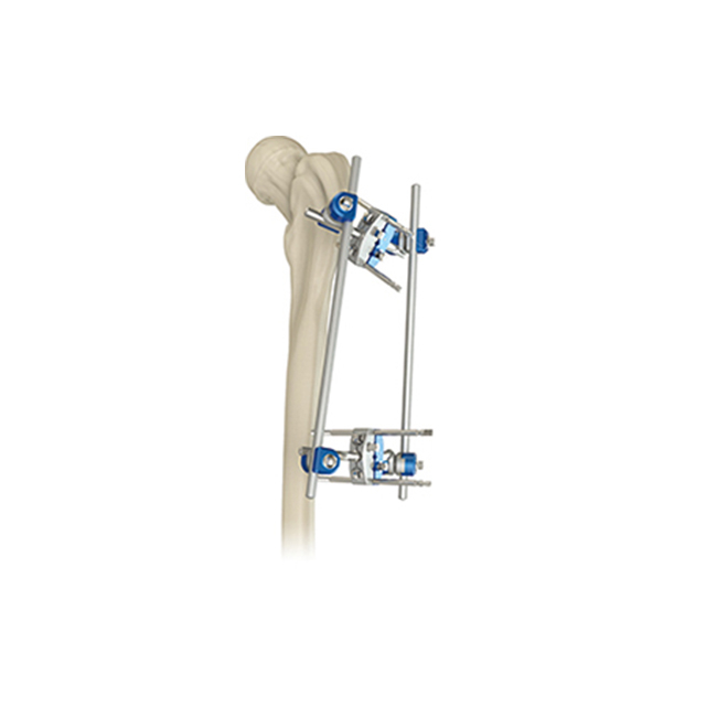 Hoffman Design Combinational Proximal Femur External Fixators for Orthopedic Fixation