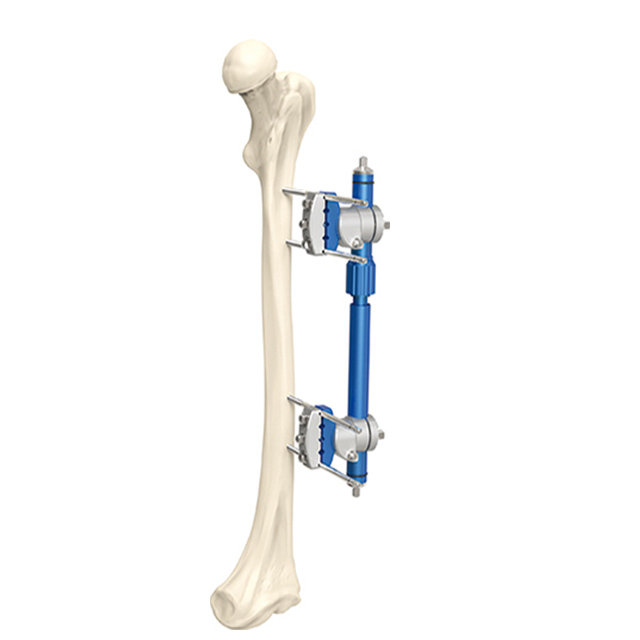 Hoffman Design Combinational Micro-motion Type External Fixators for Orthopedic Fixation